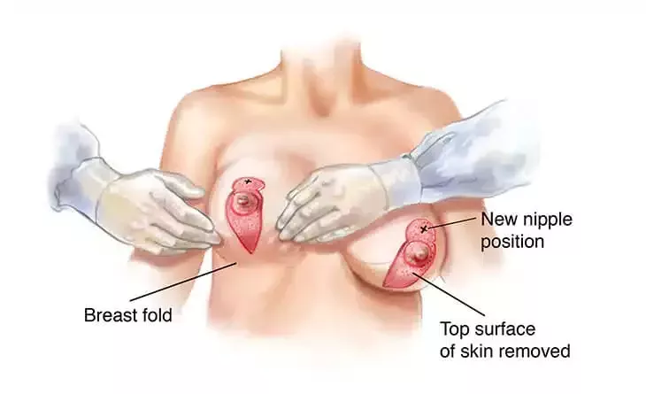 breast-lift-surgery-techniques-compared-what-works-best-big-0