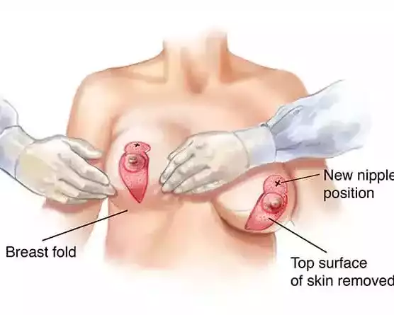 breast-lift-surgery-techniques-compared-what-works-best