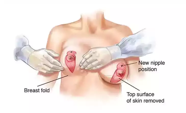 breast-lift-surgery-techniques-compared-what-works-best-big-0