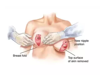 breast-lift-surgery-techniques-compared-what-works-best-small-0