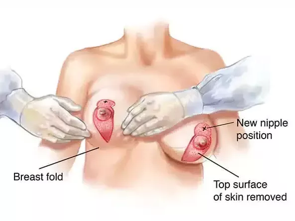 breast-lift-surgery-techniques-compared-what-works-best