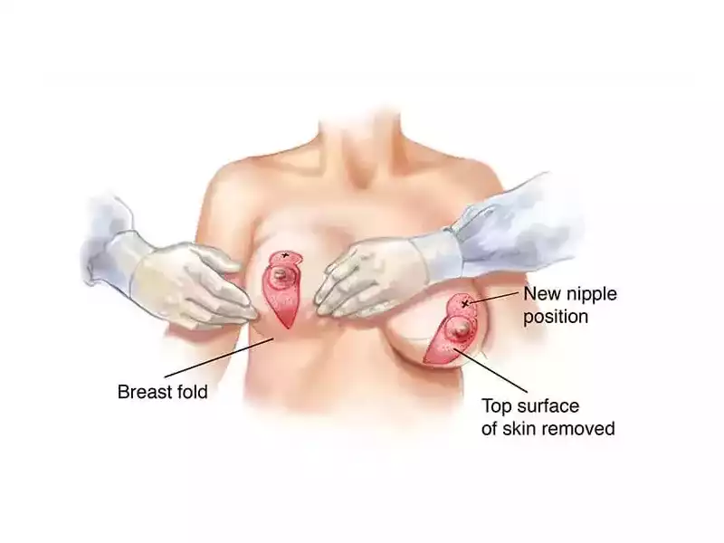 breast-lift-surgery-techniques-compared-what-works-best-small-0