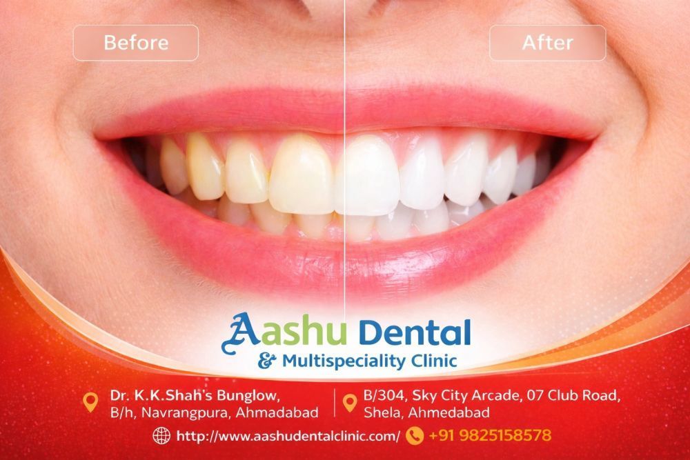restore-your-smile-with-full-mouth-rehabilitation-treatment-big-0