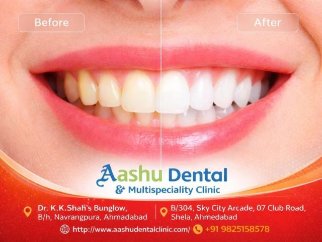 restore-your-smile-with-full-mouth-rehabilitation-treatment