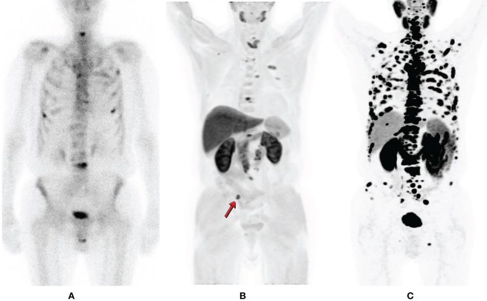 psma-pet-ct-scan-for-prostate-cancer-detection-picture-this-big-0
