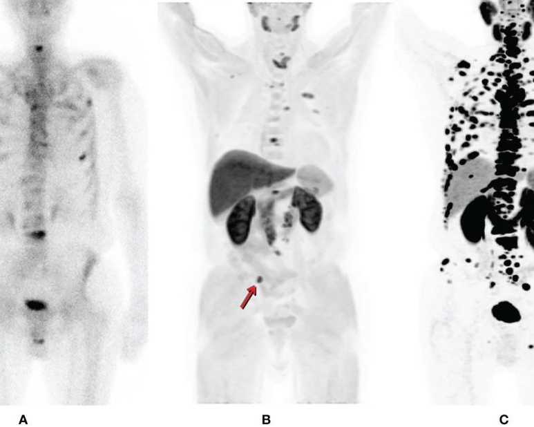 psma-pet-ct-scan-for-prostate-cancer-detection-picture-this