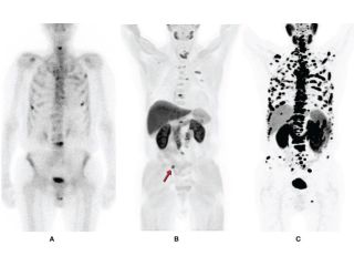 psma-pet-ct-scan-for-prostate-cancer-detection-picture-this-small-0