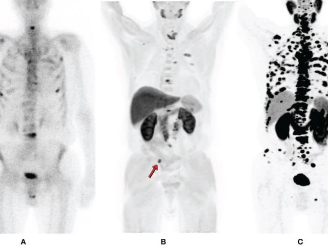 psma-pet-ct-scan-for-prostate-cancer-detection-picture-this