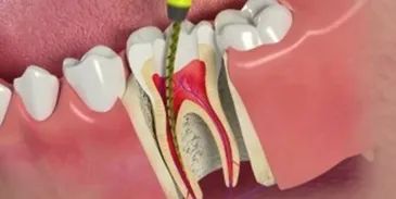 creating-smiles-precise-root-canal-surgery-in-new-town-big-0