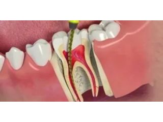 creating-smiles-precise-root-canal-surgery-in-new-town-small-0