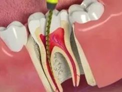 creating-smiles-precise-root-canal-surgery-in-new-town
