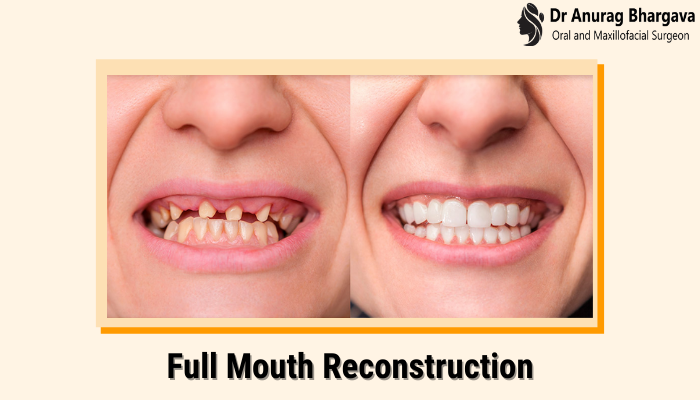 teeth-reconstruction-for-a-confident-smile-dr-anurag-bhargava-big-0
