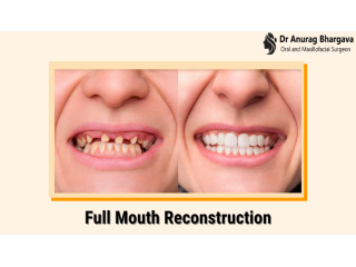 teeth-reconstruction-for-a-confident-smile-dr-anurag-bhargava-small-0