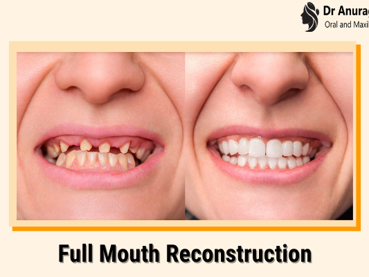 teeth-reconstruction-for-a-confident-smile-dr-anurag-bhargava