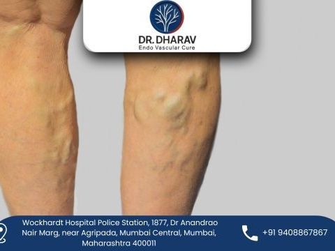 gentle-varicose-veins-treatment-in-india-by-dr-dharav-kheradia