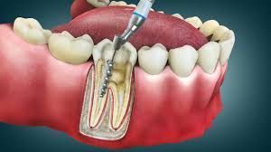 advanced-root-canal-treatment-in-chetla-big-0