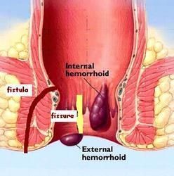 fissure-specialist-doctor-in-kalyan-west-mumbai-big-0