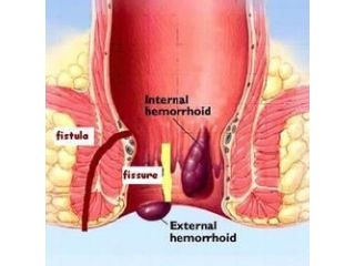 fissure-specialist-doctor-in-kalyan-west-mumbai-small-0