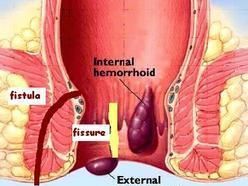 fissure-specialist-doctor-in-kalyan-west-mumbai