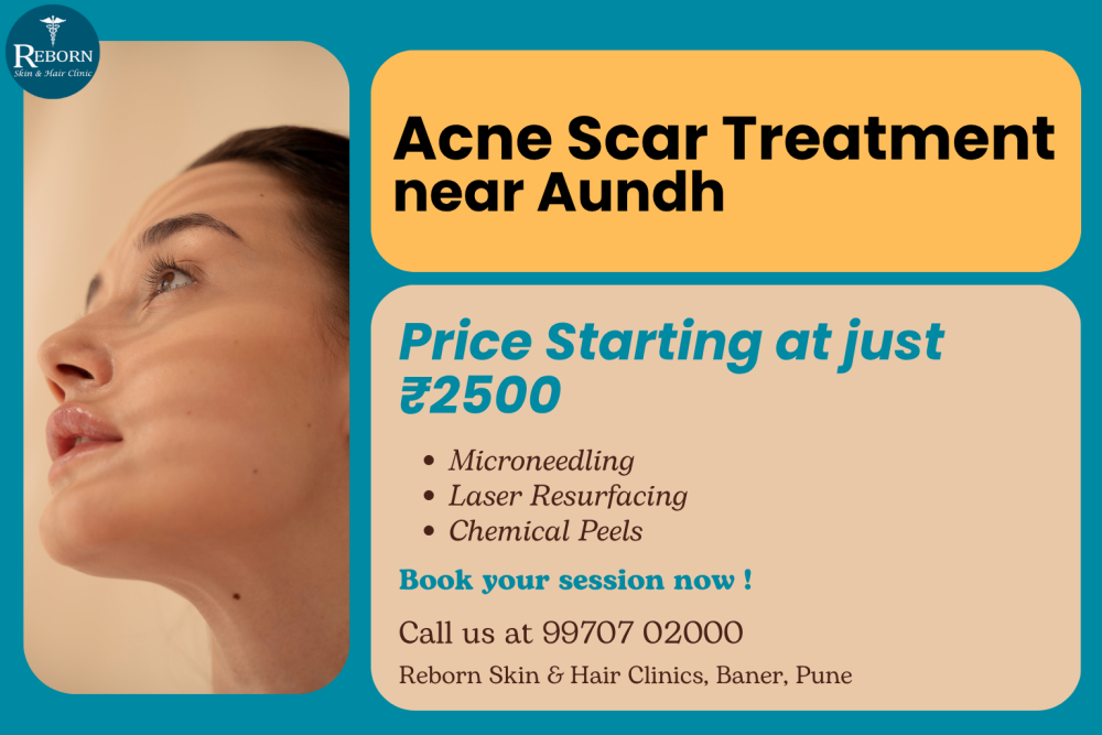 acne-scar-treatment-near-aundh-for-pune-commuters-big-0
