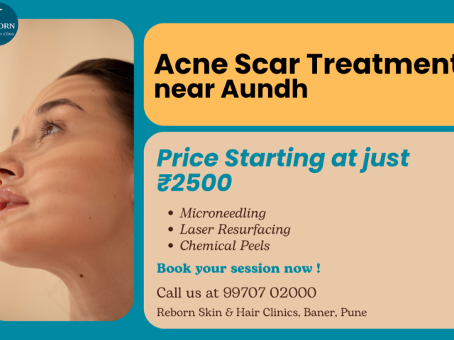 acne-scar-treatment-near-aundh-for-pune-commuters
