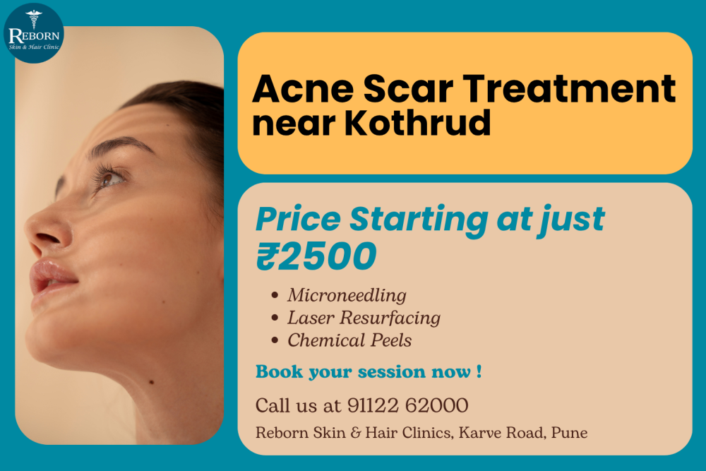 get-clearer-skin-with-acne-scar-treatment-near-kothrud-big-0