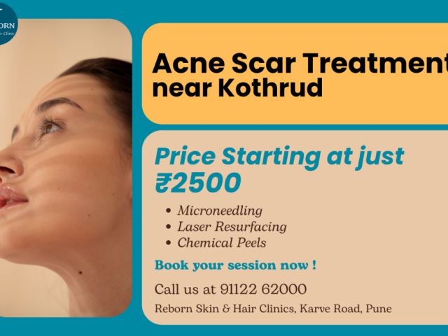 get-clearer-skin-with-acne-scar-treatment-near-kothrud