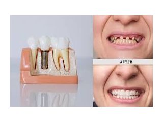 best-dental-implant-clinic-in-chetla-for-perfect-smile-small-0