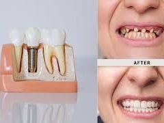 best-dental-implant-clinic-in-chetla-for-perfect-smile