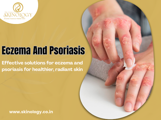 eczema-psoriasis-treatment-in-indore-by-experts