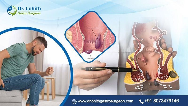 get-the-best-piles-treatment-in-bangalore-today-big-0