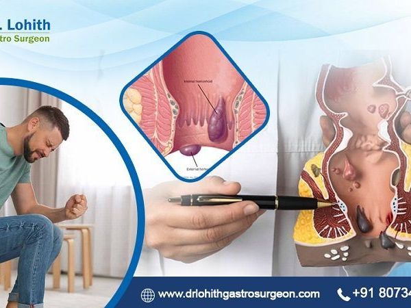 get-the-best-piles-treatment-in-bangalore-today