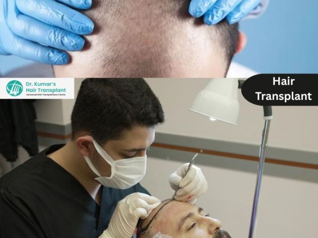 advanced-hair-restoration-solutions-in-kondapur-with-expert-care