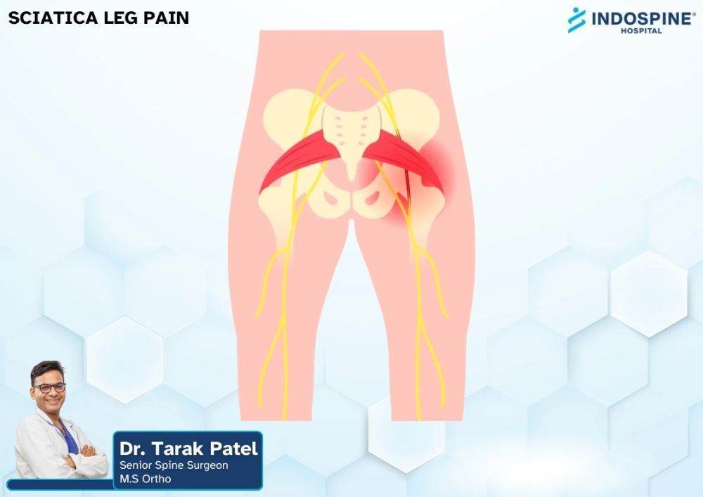 effective-sciatica-leg-pain-treatment-relief-from-nerve-pain-big-0