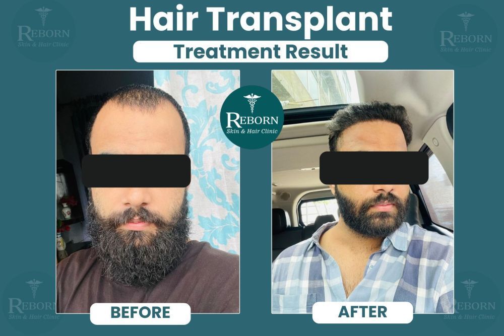 hair-transplant-in-jaipur-get-a-natural-hairline-back-at-rs29999-big-2