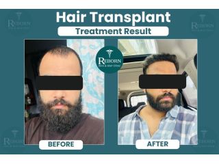 hair-transplant-in-jaipur-get-a-natural-hairline-back-at-rs29999-small-2