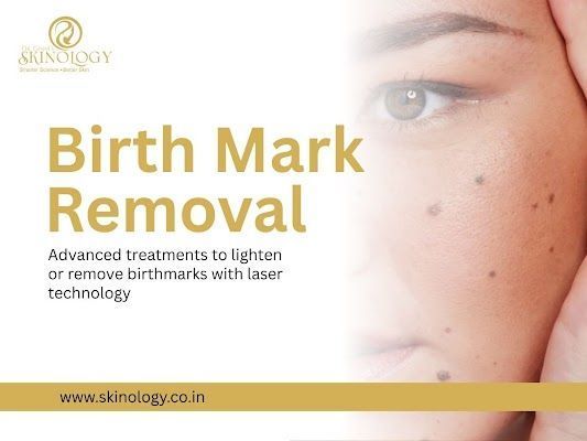 permanent-birthmark-removal-treatment-in-indore-big-0