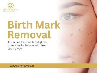 permanent-birthmark-removal-treatment-in-indore-small-0