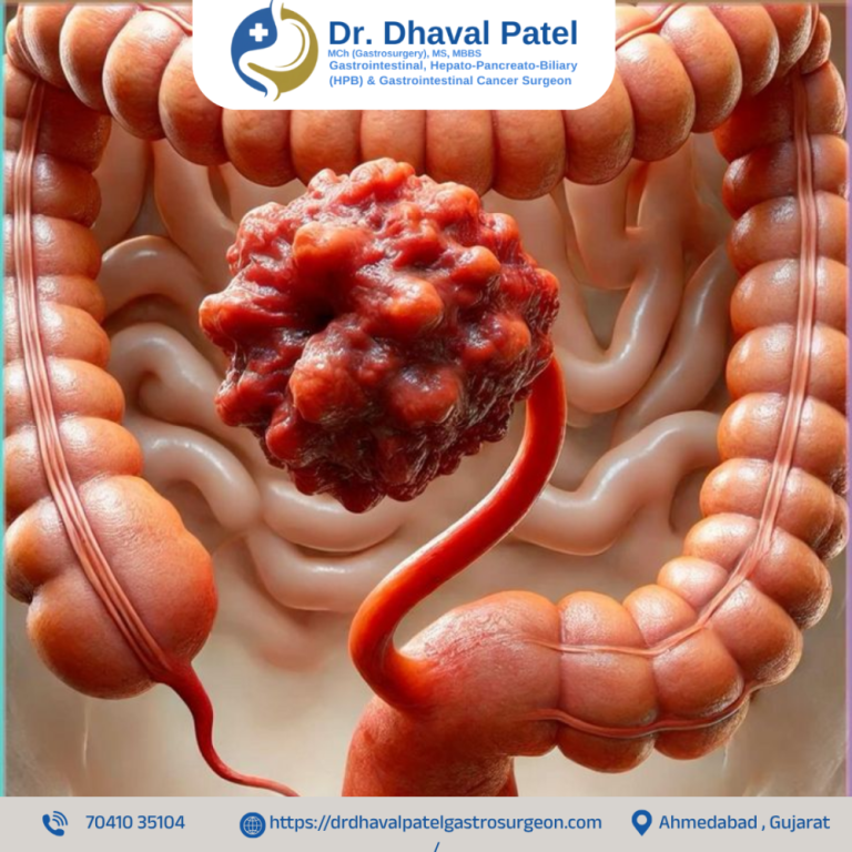 colon-cancer-surgery-in-ahmedabad-with-dr-dhaval-patel-big-0