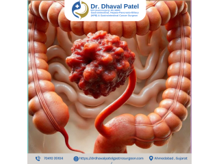 colon-cancer-surgery-in-ahmedabad-with-dr-dhaval-patel-small-0