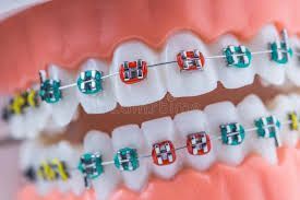 best-dental-braces-in-chetla-for-perfect-smile-big-0