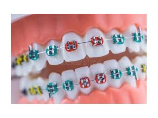 best-dental-braces-in-chetla-for-perfect-smile-small-0