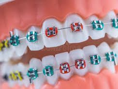 best-dental-braces-in-chetla-for-perfect-smile
