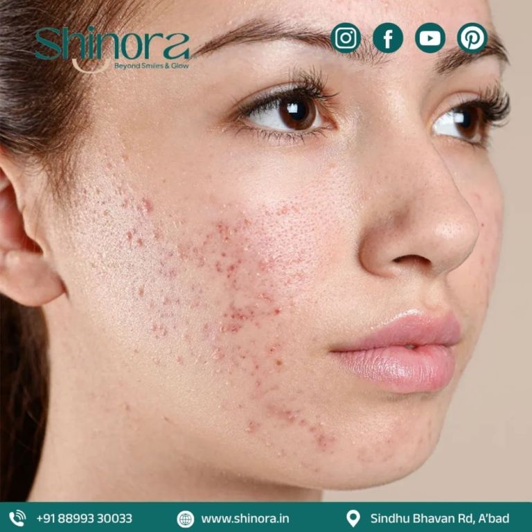 acne-scar-treatment-in-ahmedabad-for-advanced-skin-solutions-big-0