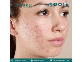 acne-scar-treatment-in-ahmedabad-for-advanced-skin-solutions-small-0