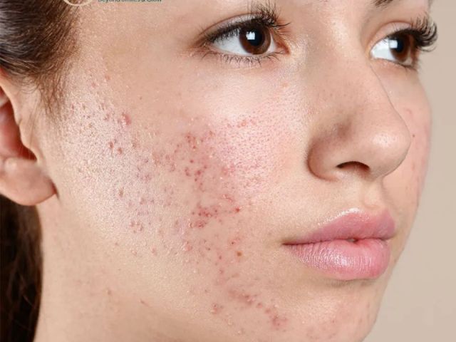 acne-scar-treatment-in-ahmedabad-for-advanced-skin-solutions