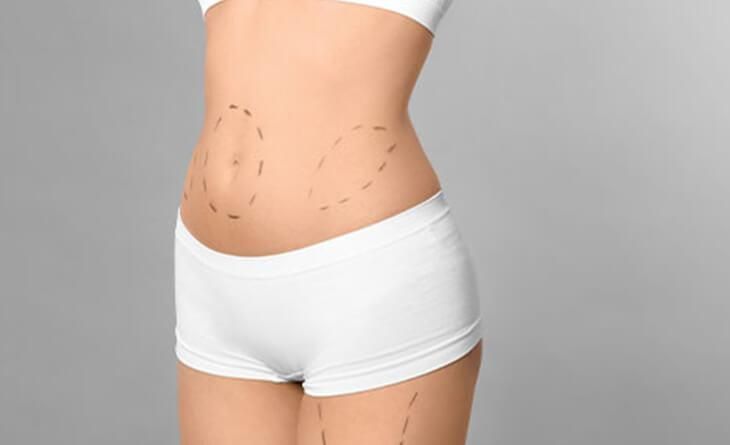 what-is-the-cost-of-liposuction-surgery-big-0