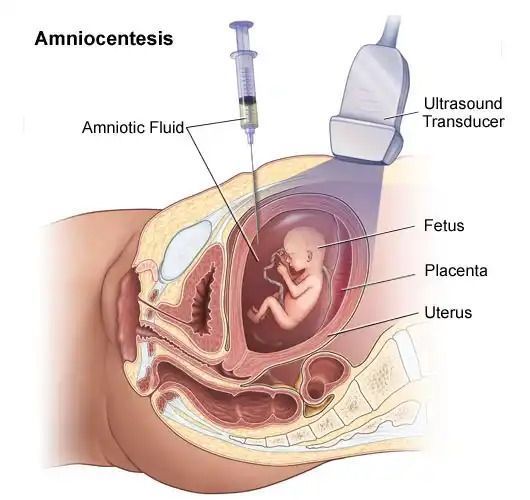 budget-amniocentesis-test-fetal-india-big-0
