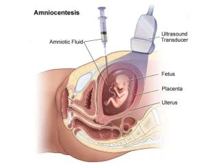 budget-amniocentesis-test-fetal-india-small-0