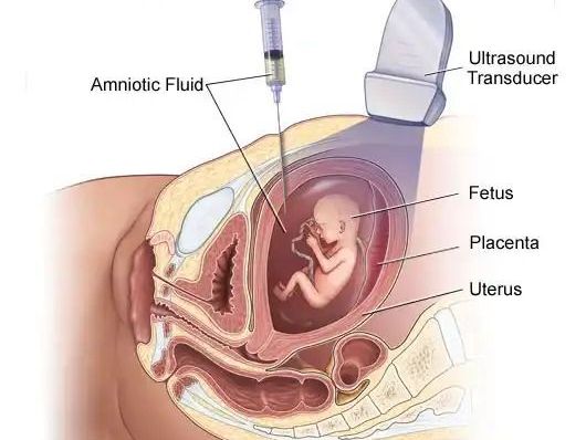 budget-amniocentesis-test-fetal-india